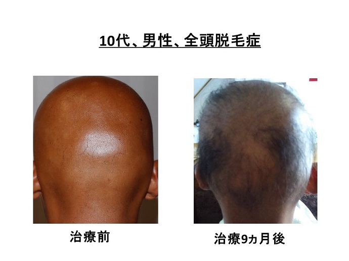 円形脱毛症　病院